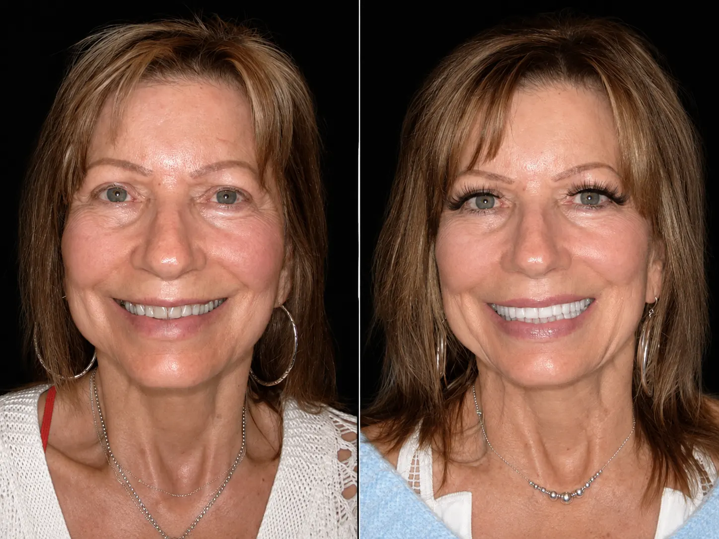 Before and after smile makeover by Dallas cosmetic dentist Dr. Ritchie Beougher — SmileLift™ at Smile Maker of Texas, Plano
