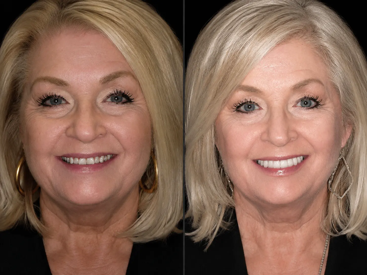 Before and after smile makeover by Dallas cosmetic dentist Dr. Ritchie Beougher — SmileLift™ at Smile Maker of Texas, Plano