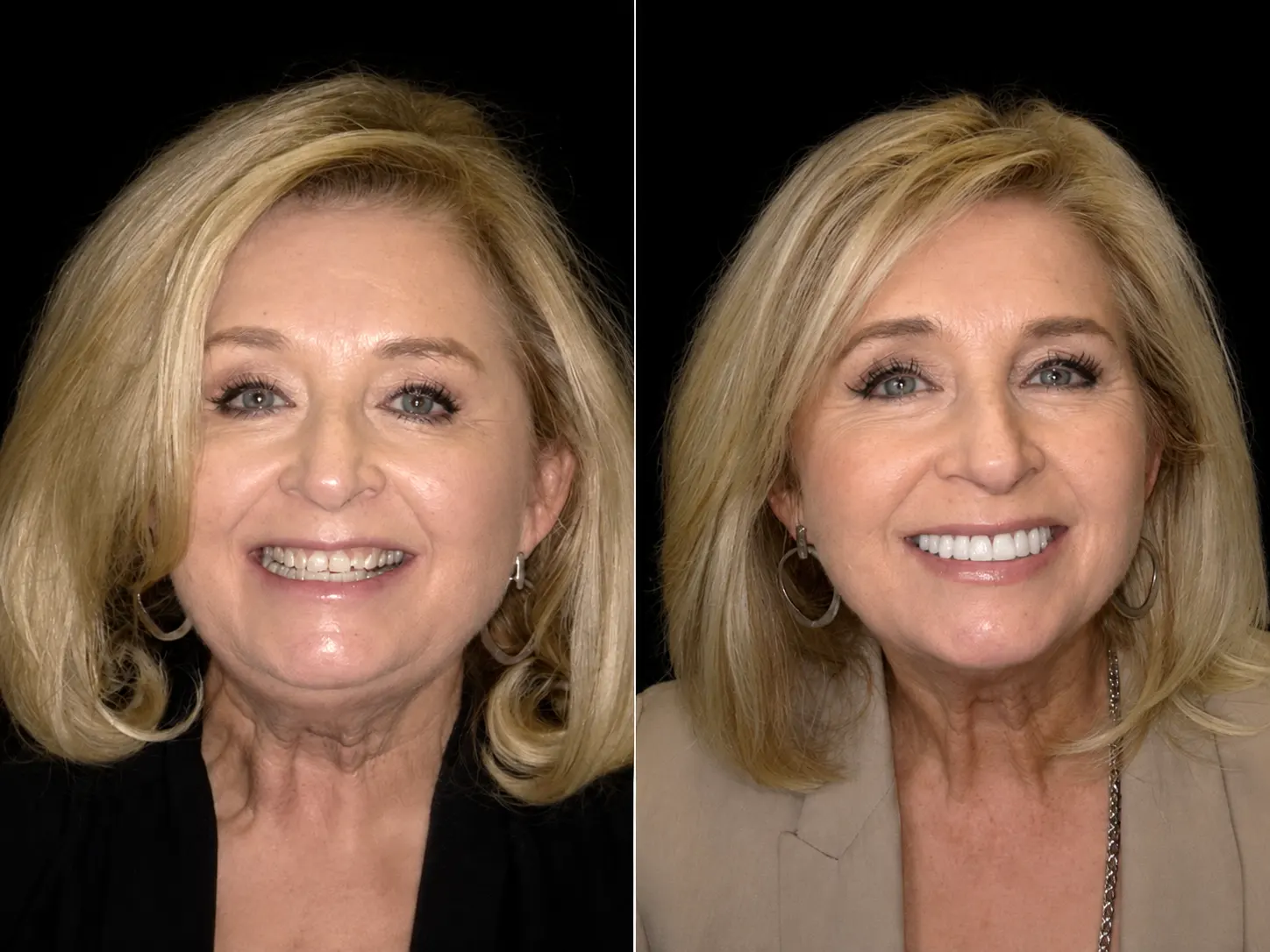 Before and after smile makeover by Dallas cosmetic dentist Dr. Ritchie Beougher — SmileLift™ at Smile Maker of Texas, Plano