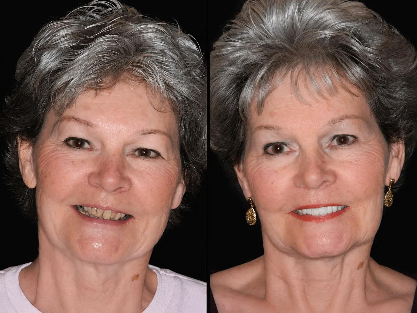 Before and after smile makeover by Dallas cosmetic dentist Dr. Ritchie Beougher — SmileLift™ at Smile Maker of Texas, Plano