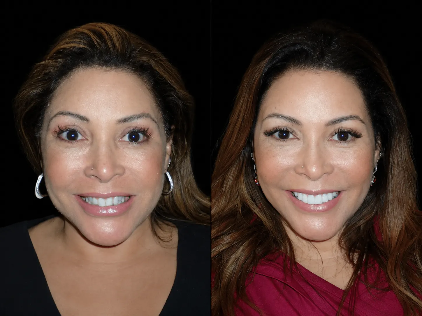 Before and after smile makeover by Dallas cosmetic dentist Dr. Ritchie Beougher — SmileLift™ at Smile Maker of Texas, Plano