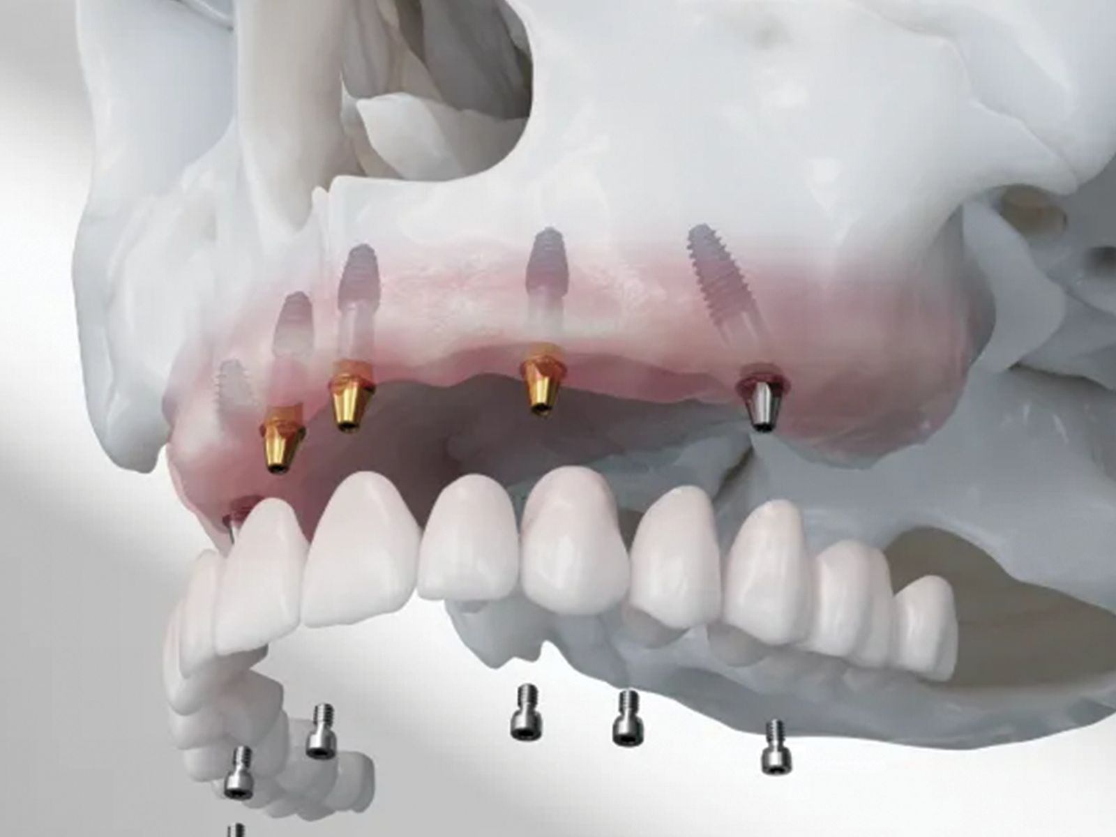 A full-arch All-on-X implant bridge used to replace all upper or lower teeth